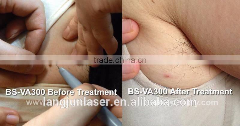 Beautiful Professional Cure Telangiectasia Treatment Vein Removal Equipment