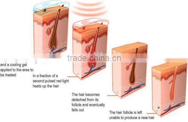 Multifunction ipl shr e-light machine with CE FDA approval