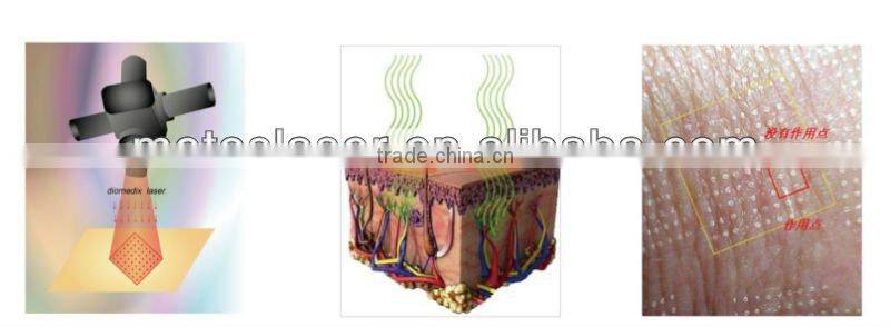 Fractional CO2 Vaginal Tightening Laser