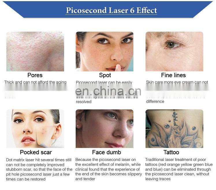 Picolaser tattoo removal machine