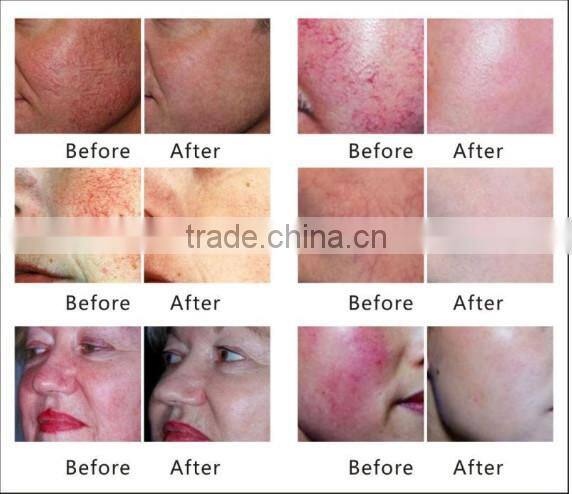 spider vein removal use 30MHz handled vascular doppler equipment for sale