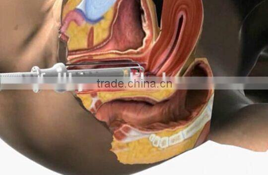 Korea technology! laser vaginal tightening co2 fractional/high-tech RF tube