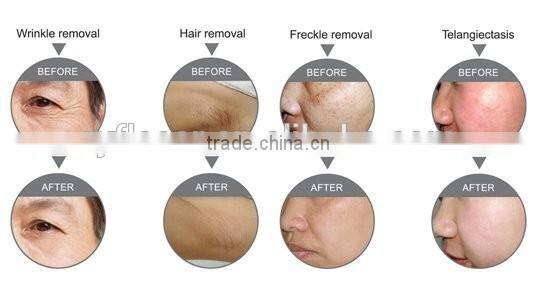 hair removal / Portable ipl laser hair removal machine / ipl home