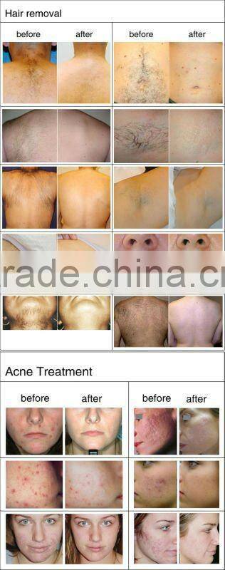 High quality ipl/rf hair removal machine with factory price