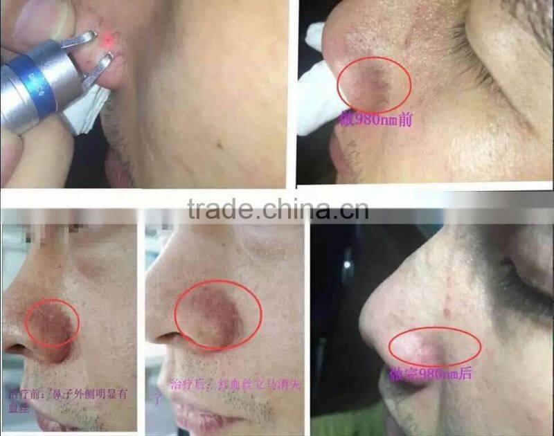 Vascular Removal Laser 980 Machine