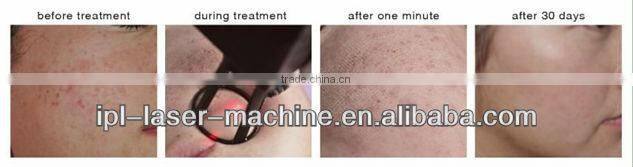 fractional co2 laser acne scar removal