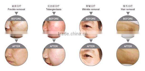 Amber Multifunction IPL beauty machine