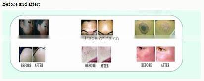 hot sales new generation Elight+RF+ND YAG LASER in one for hair treatment and skin care