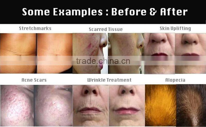 Hot sale Skin Care Therapy Dermatology System Mns Derma Roller