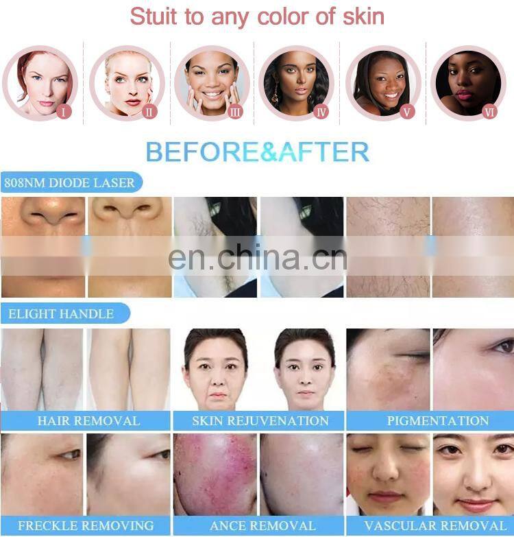 Big spot 808 ipl rf yag germany lazer epilation carbon laser peel hair removal elight beauty machine