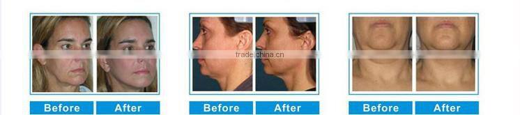 Professional HFU facial contouring best-sale High Intense Focus Ultrasound HFU10
