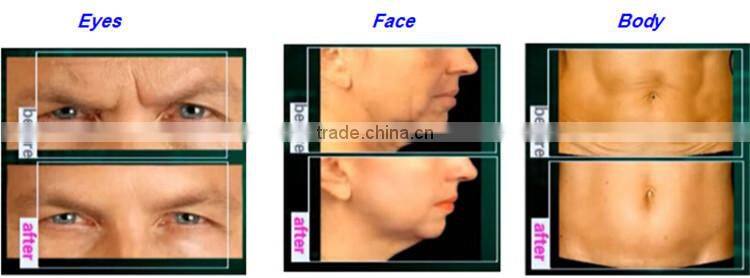 portable rf skin tightening machine wrinkle removal