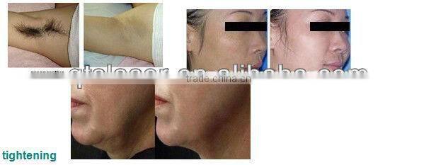 Hot sell hair removal beauty product King ! 808nm diode Laser
