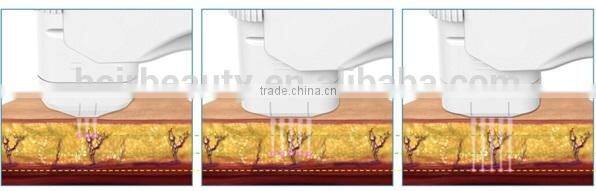 SMAS High Intensity Focus Ultrasound System clinic Skin rejunveation beauty Machine