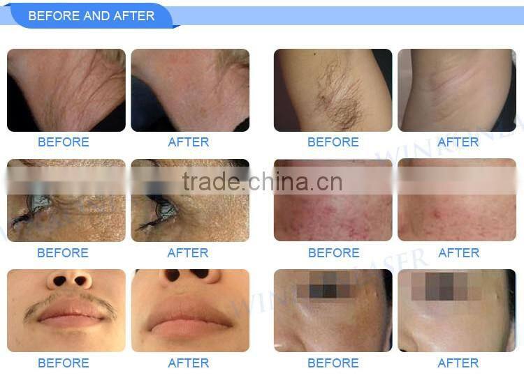 Permanent unhairing korea big spot laser ipl machine for painless hair removal