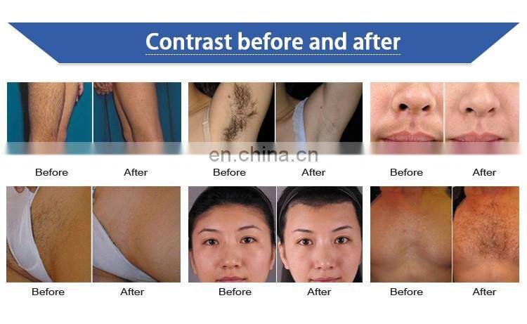 diode 808 diode laser hair removal machine