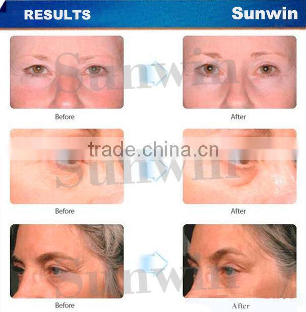 hifu for skin tightining beauty machine SW-131B