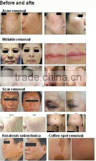 ce hair removal laser Er glass laser machine /laser therapy equipment/top laser /tattoo removal machine