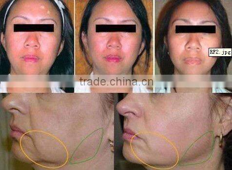 Multi Polar RF Radio Frequency Machine-B005