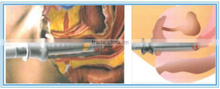 Medical equipments Fractional co2 Laser for scar removal