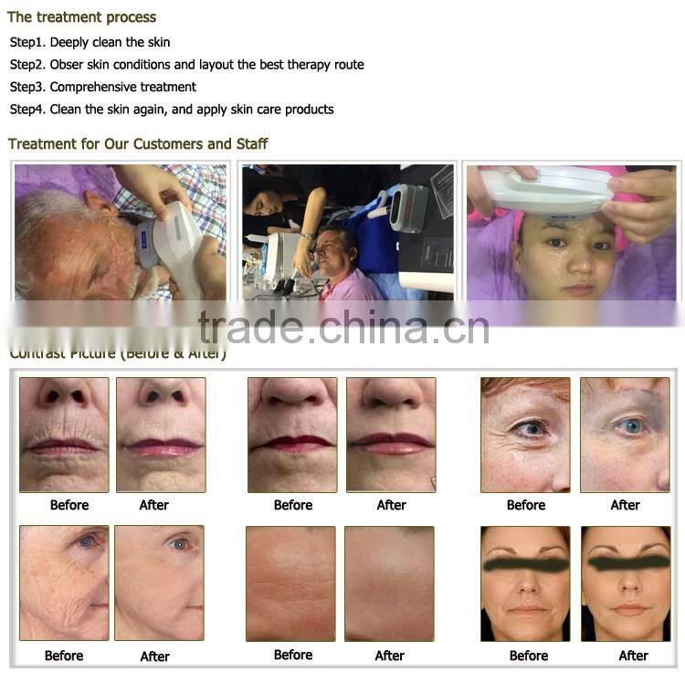 Medical CE Approved top quality 4 tips face lifting hifu korea OD-H6