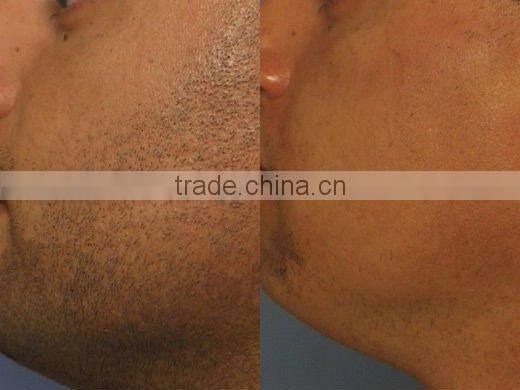 Best package and easy operation ipl laser photofacial hair removal machine for home use