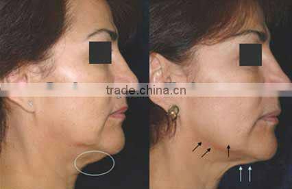 2014 newest rf machine with high-tech humanized design for skin lifting