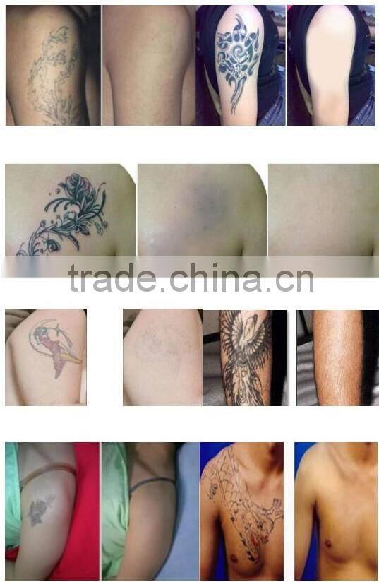 tattooist wanted yag picosecond laser tattoo removal machine with 1064nm532nm