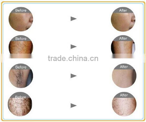 2016 vertical high performance 808 diode laser hair removal/808 laser hair removal machine