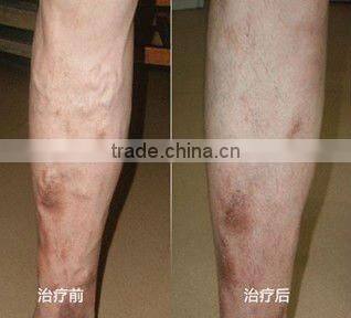 Portable Painless lightsheer long pulse hair free laser