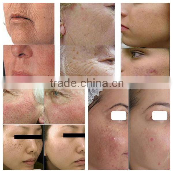 Beauty salon equipment Golden Supplier !!! Best E-light IPL SHR Hair Removal Laser 3 in 1 laser hair removal machine for sale