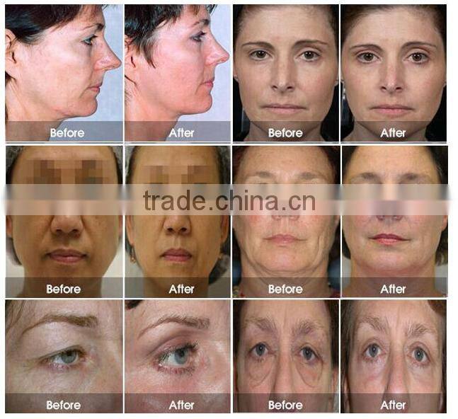 Portable OPT Shr Hair Removal Machine and skin rejuvenation machine