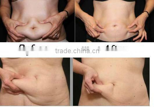 New RF beauty cavitation relaxes tensed muscles machine(Double)