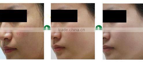 Vascular Removal Laser 980 Machine