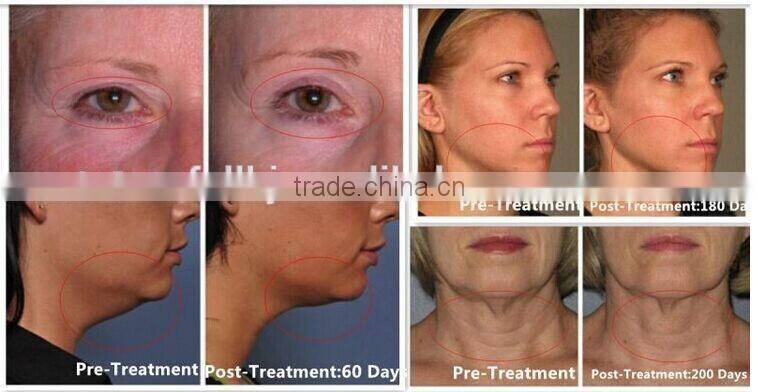 Hot hifu with medical CE