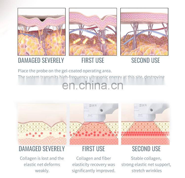 lipo+ HIFU 2 in 1 anti-wrinkle body cellulite removal treatment system equipment with CE