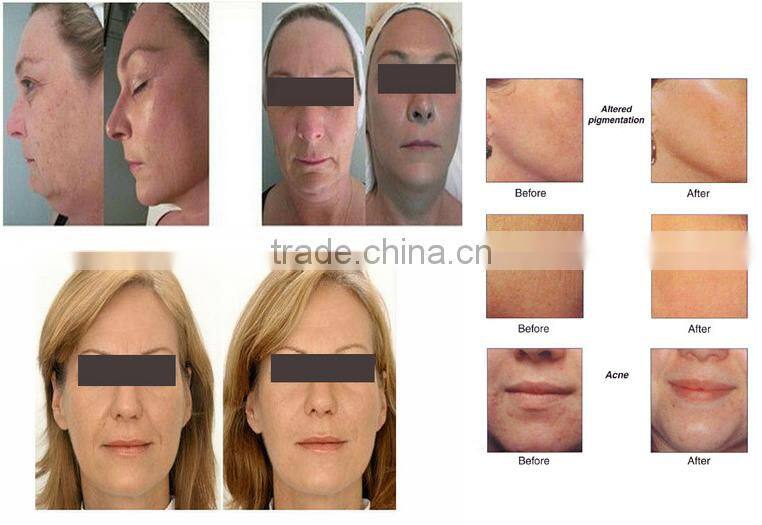 diamond tip microdermabrasion exfoliator removal machine