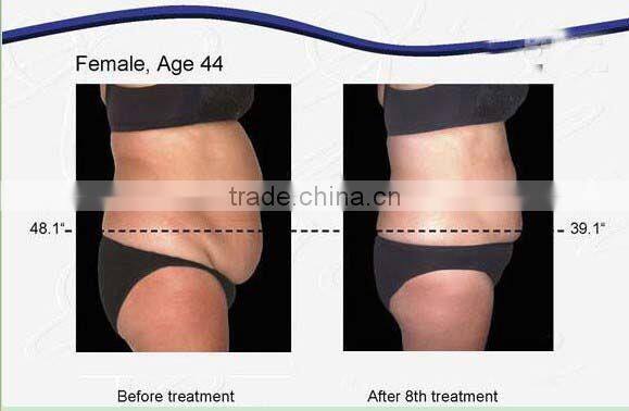 2016 weight loss slimming 3 cryo handles cryolipolysis