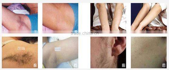 Free shipping and hot selling epilia diode laser hair removal for painless hair removal