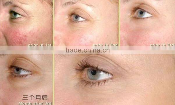 Eye cream applicator wrinkle filler micro current anti wrinkle pen
