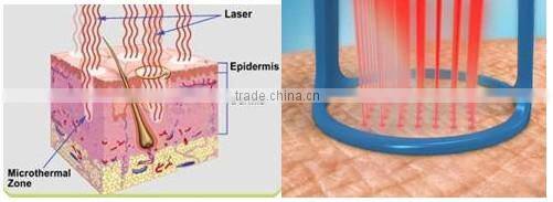 Multifunction skin tightening machine whitening products rejuvi tattoo removal SALE !