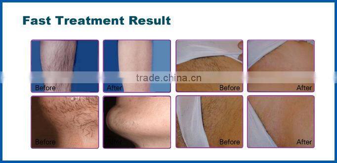 portable fast and efficient permanent 808 hair removal laser diodo 808nm portable(CE/ISO/TUV/ROHS)