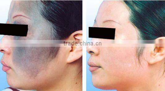 q switched nd yag tattoo removal and wrinkle remover laser machine with 7 joind light guiding arm