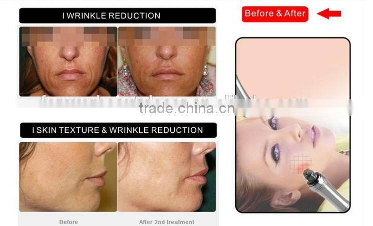 Microneedle fractional radio frequency machine-MNF100 promotion price on sale