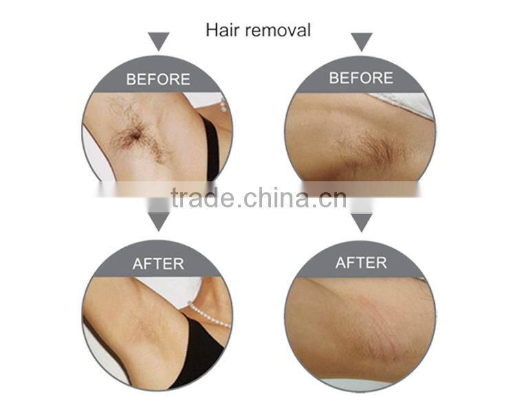 face hair removal permanent for beauty salon