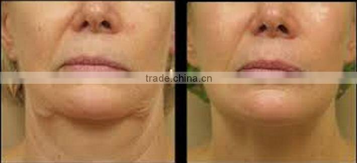 Top selling cryolipolysis cold body sculpting machine with vacuum massage