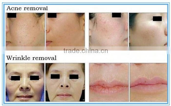 Professional Co2 fractional laser equipment for scars removal