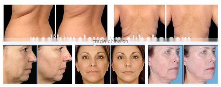 hotlaser fat burning vacuum roller massage machine slimming machine