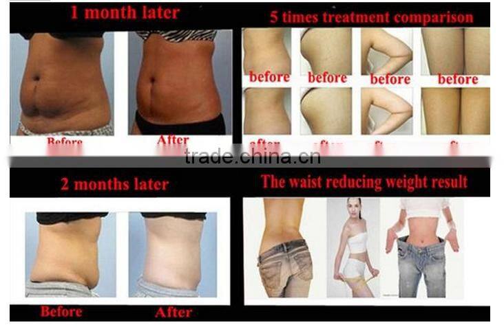 Wholesale 360-Degree cryo lipo fat cell slimming machine