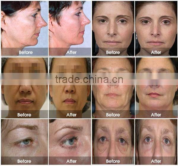 LM-S809B Best 2016 Wrinkle Remover Feature hifu ultrasound machine